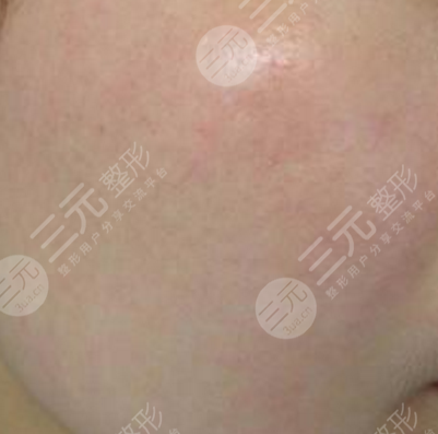 去脸部红血丝