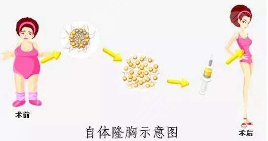 脂肪填充胸部多久恢复自然?