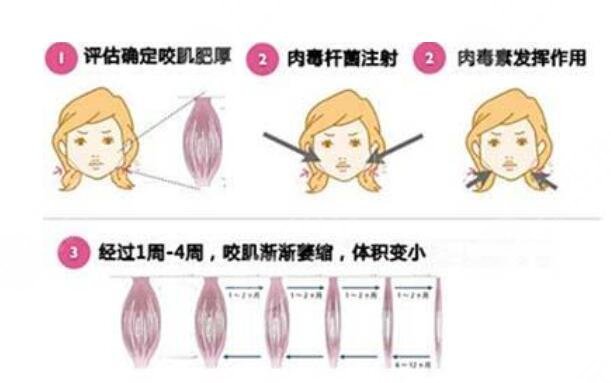 注射瘦脸的原理是什么