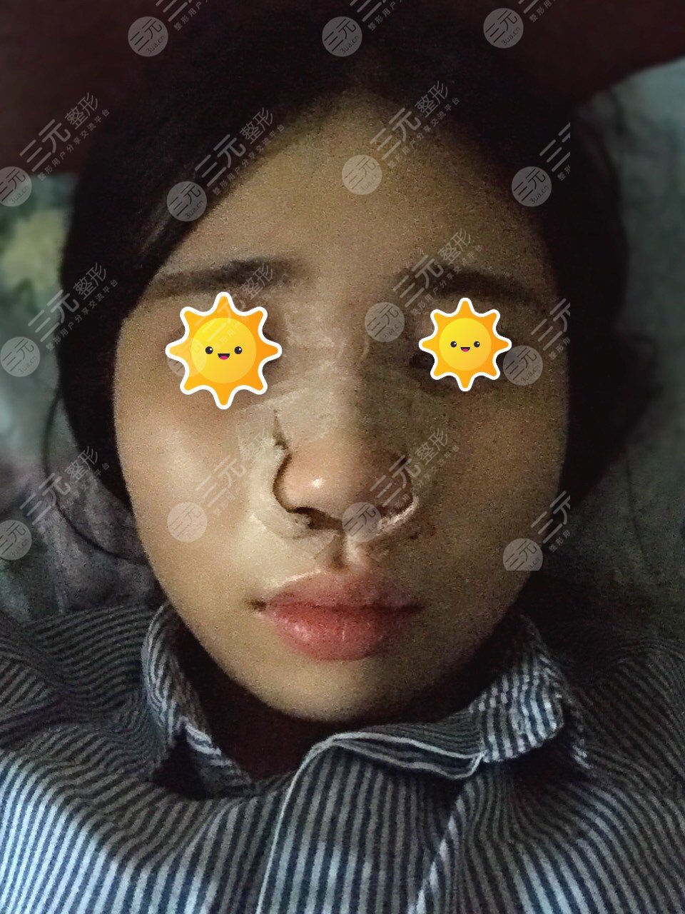 兰大二院整形外科隆鼻案例