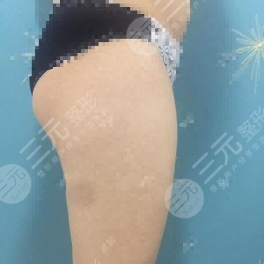 北京上上相医疗美容诊所大腿吸脂案例