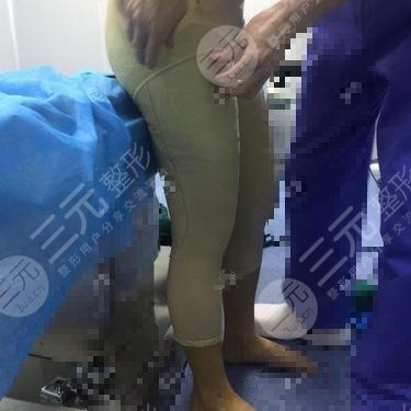 北京上上相医疗美容诊所大腿吸脂案例