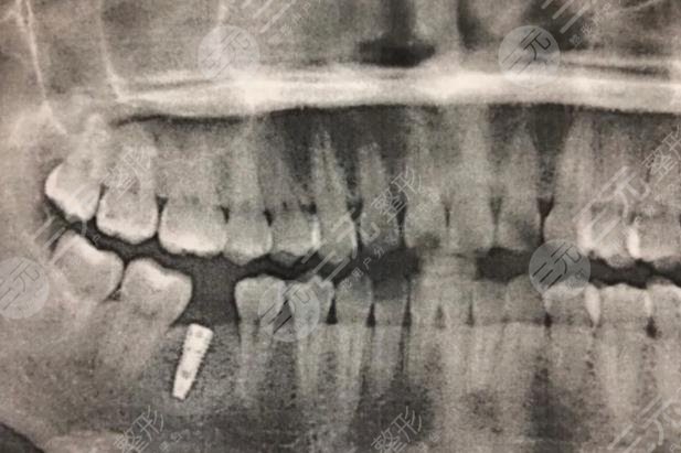 厦门市口腔医院种植牙手术经历分享