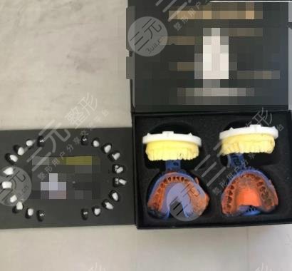 厦门登特口腔医院牙齿瓷贴面过程分享