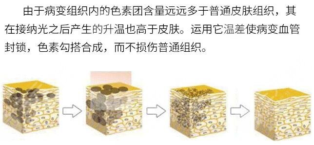怎样去除老年斑