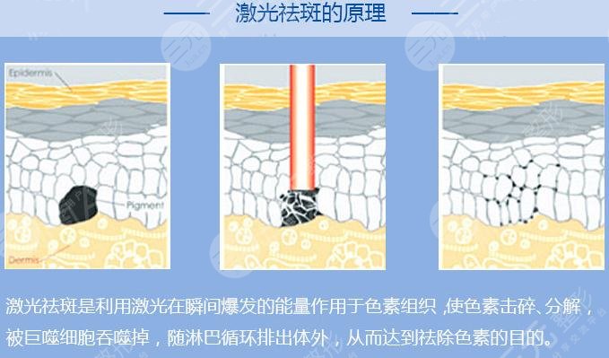 怎样去除老年斑