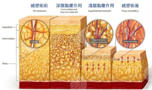 吸脂手术减肥纤体