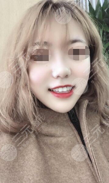 激光嫩肤后