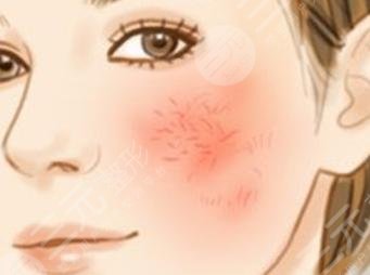 缓解脸部红血丝的方法，这3种方法让你摆脱“高原红”！