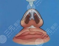 注射隆鼻能维持多长时间？注射隆鼻怎么做可以延长维持时间？