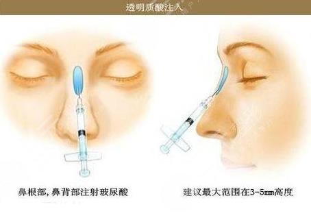 注射隆鼻能维持多长时间