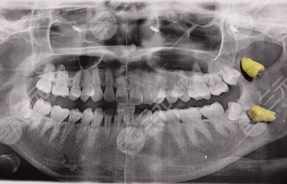 荆门雅泰口腔医院拔智齿经历