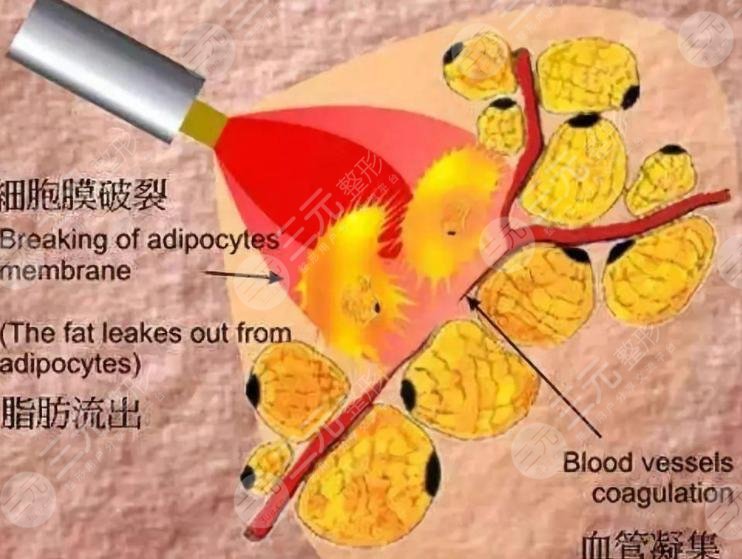 光纤溶脂好不好?光纤溶脂的价格是多少?光纤溶脂瘦腿案例