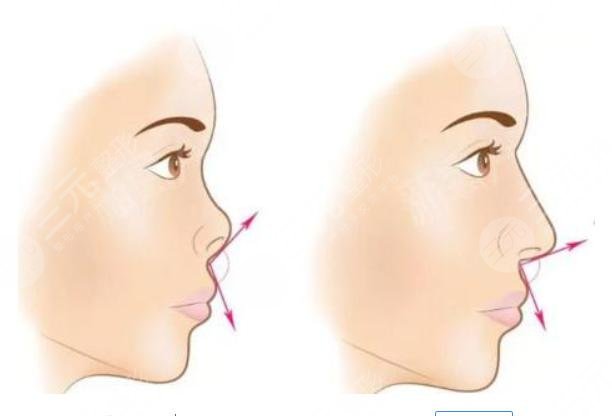 朝天鼻如何矫正靠谱？朝天鼻矫正方式+朝天鼻矫正真实案例