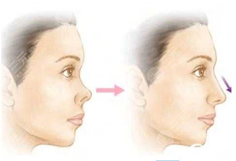 朝天鼻如何矫正靠谱