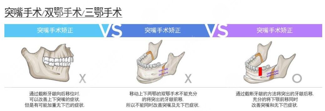 韩国双鄂手术原理是什么