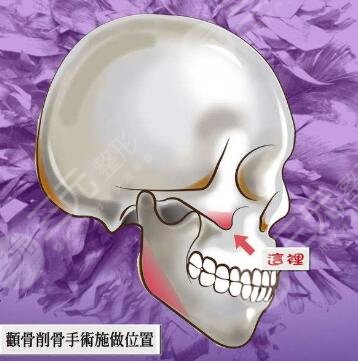 韩国双鄂手术注意事项有哪些
