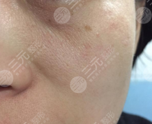 皮肤松弛毛孔粗大怎么办?做好这5点可以轻松收获年轻美肌! 皮肤松弛毛孔粗大怎么办?做好这5点可以轻松收获年轻美肌!