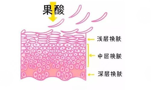 果酸换肤一辈子一直都要做吗？果酸换肤适合人群有哪些？