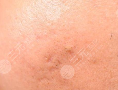 减少痤疮疤痕产生