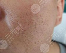 怎么去除痤疮疤痕？本文来详解去除痤疮疤痕的方法大全~