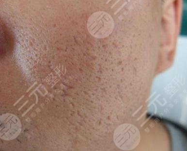 怎么去除痤疮疤痕？本文来详解去除痤疮疤痕的方法大全~