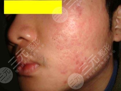 去除痤疮疤痕的小妙招