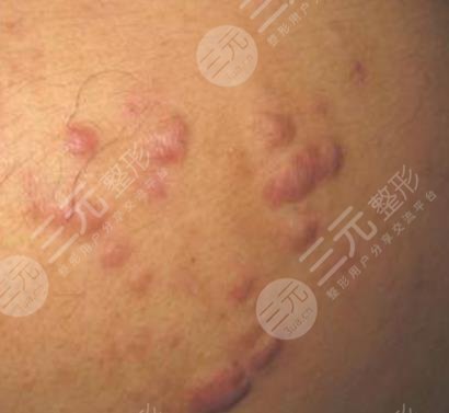 怎样减少痤疮疤痕产生