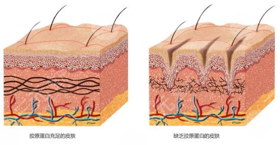 内窥镜除皱术的注意事项罗列