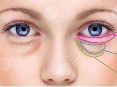 怎样有去除眼袋的方法有哪些？这7个小技巧要要学起来哦！