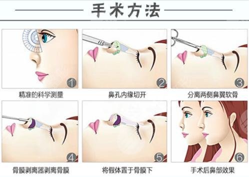 假体隆鼻是什么