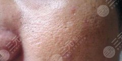怎么缓解毛孔粗大比较有果？缓解毛孔粗大的真实案例果~
