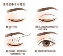 做双眼皮手术恢复时间查询，双眼皮手术价格+双眼皮案例果