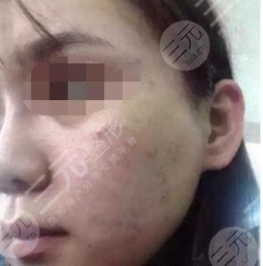 真人果酸换肤后一个月