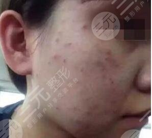 真人果酸换肤前