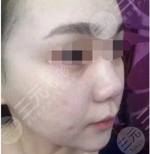 真人果酸换肤后2个月