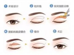 割双眼皮好还是埋线好？不怕纠结症，“亘古难题”为你解答！