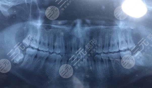 深圳美奥口腔医院智齿缓解