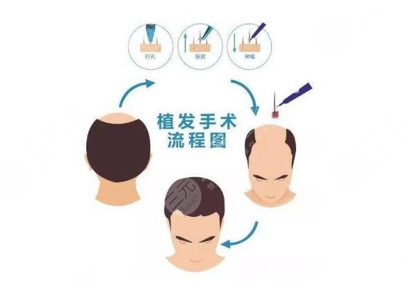 植发手术过程是怎样的