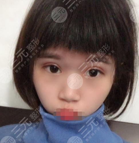 开眼角手术后3个月