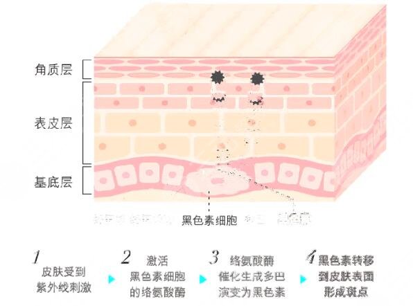 像素激光缓解是什么