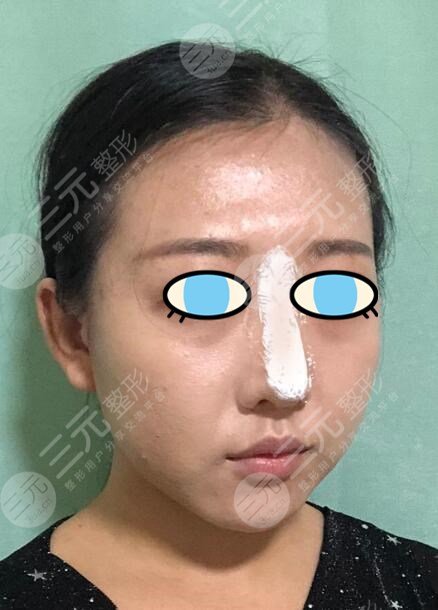 韩式注射式隆鼻中