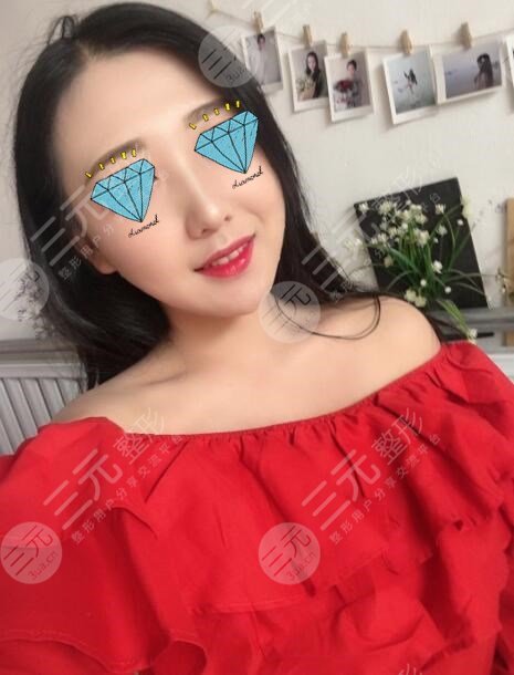 韩式注射式隆鼻后