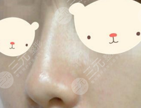 注射隆鼻的好处和优势有哪些