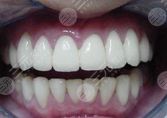 做烤瓷牙要多长时间？烤瓷牙的后遗症有哪些？烤瓷牙能够维持多久？