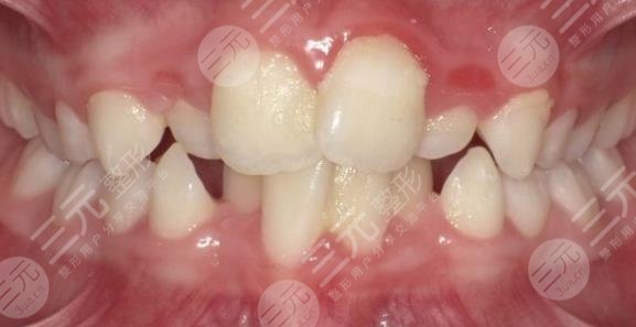 昆明尚爱韩美口腔医院儿童牙齿矫正缓解