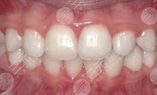 昆明尚爱韩美口腔医院儿童牙齿矫正缓解