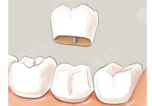 烤瓷牙的种类及价钱科普！牙齿修复必看攻略！