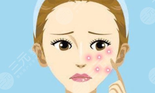 激光祛痘大概要多少钱？超全科普讲解你的痘肌耗费多少米！