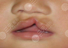 兔唇整形需要多少钱？兔唇整形的注意事项有哪些？